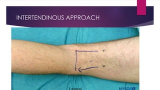 INTERTENDINOUS APPROACH
ST
BF
 