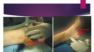 SURAL NERVE
BLOCK
POSTERIOR
TIBIAL N
BLOCK
 