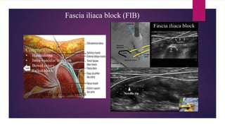 Fascia iliaca block (FIB)
Complications:
• Haematoma
• Intra-vascular injection
• Bowel injury
• Failed block
 