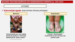 QUADRO SOCIOECONÔMICO DO SUBDESENVOLVIMENTO (p. 234-253)
 Subnutrição aguda: duas formas clínicas principais:
A FOME
Marasmo Kwashiorkor
Caracterizada por uma rápida
perda de gordura e músculos
(aparência de “pele e osso”)
Criança “desmamada”.
Caracteriza-se por inchaço nas
pernas e pés.
 