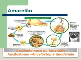 Ancilostomose ou Amarelão
Ancilóstomo -Ancylostoma duodenale
 