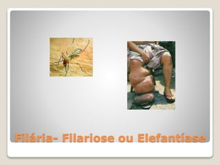 Filária- Filariose ou Elefantíase
 