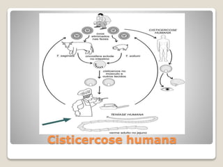 Cisticercose humana
 