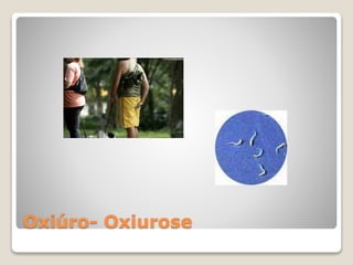 Oxiúro- Oxiurose
 