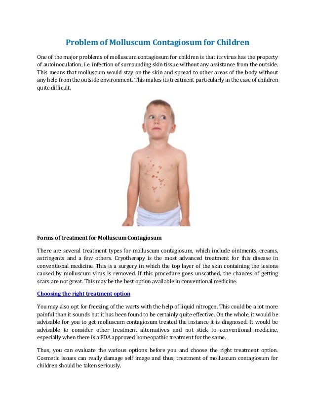 Problem of Molluscum Contagiosum for Children