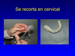 Se recorta en cervical 