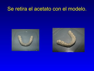 Se retira el acetato con el modelo. 