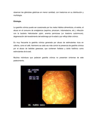 observan las glándulas gástricas en menor cantidad, con trastornos en su distribución y
morfología.
Etiología.

La gastritis crónica puede ser ocasionada por los malos hábitos alimenticios, el estrés, el
abuso en el consumo de analgésicos (aspirina, piroxicam, indometacina, etc.), infección
con la bacteria Helicobacter pylori, anemia perniciosa (un trastorno autoinmune),
degeneración del revestimiento del estómago por la edad o por reflujo biliar crónico.

Es muy frecuente la gastritis crónica generada por abuso de estimulantes ricos en
cafeína, como el café. Asimismo es cada vez más común la presencia de gastritis crónica
por el abuso de bebidas gaseosas, que contienen fosfatos y ácido fosfórico como
estimulantes de la sed.

Muchos individuos que padecen gastritis crónica no presentan síntomas de este
padecimiento.

 