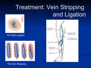 The High Ligation The Vein Stripping Treatment: Vein Stripping  and Ligation 