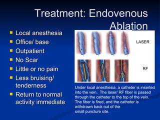 Treatment: Endovenous  Ablation  Local anesthesia  Office/ base  Outpatient No Scar Little or no pain  Less bruising/ tenderness  Return to normal activity immediate Under local anesthesia, a catheter is inserted into the vein.  The laser/ RF fiber is passed through the catheter to the top of the vein. The fiber is fired, and the catheter is withdrawn back out of the  small puncture site. LASER RF 
