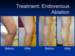 Treatment: Endovenous  Ablation  Before After  Before After  