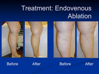Treatment: Endovenous  Ablation  Before After  Before After  