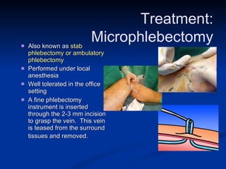 Also known as  stab phlebectomy or ambulatory phlebectomy   Performed under local anesthesia  Well tolerated in the office setting A fine phlebectomy instrument is inserted through the 2-3 mm incision to grasp the vein.  This vein is teased from the surround tissues and removed.   Treatment: Microphlebectomy 