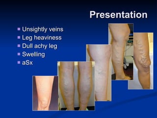 Presentation Unsightly veins Leg heaviness  Dull achy leg Swelling  aSx 
