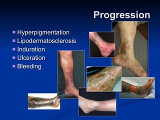 Progression Hyperpigmentation Lipodermatosclerosis Induration  Ulceration Bleeding  