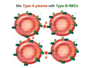 B
B
B
B
B
B
B
B
B
B
B
B
B
B
B B
B
B
B
B
B
B
B
B
B
B B
B
B
B
B
B
B
BB
Mix Type A plasma with Type B RBCs
 