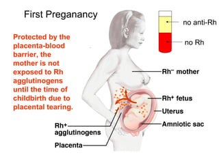 Protected by the
placenta-blood
barrier, the
mother is not
exposed to Rh
agglutinogens
until the time of
childbirth due to
placental tearing.
First Preganancy
no anti-Rh
no Rh
 