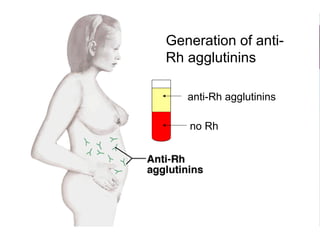 Generation of anti-
Rh agglutinins
anti-Rh agglutinins
no Rh
 