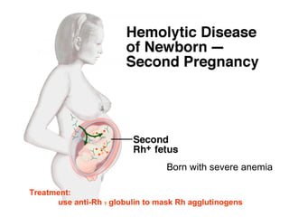 Born with severe anemia
Treatment:
use anti-Rh γ globulin to mask Rh agglutinogens
 