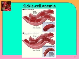 Sickle-cell anemia
28
 