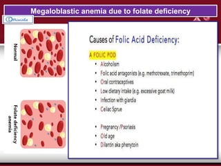 Megaloblastic anemia due to folate deficiency
 