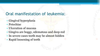 Oral manifestation of leukemia:
• Gingival hyperplasia
• Petechiae
• Ulceration of mucosa
• Gingiva are boggy, edematous and deep red
• In severe cases teeth may be almost hidden
• Rapid loosening of teeth
 