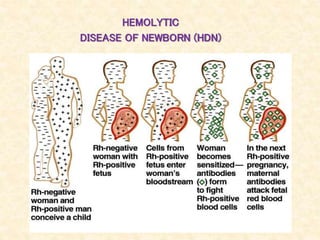 HEMOLYTIC
DISEASE OF NEWBORN (HDN)
 