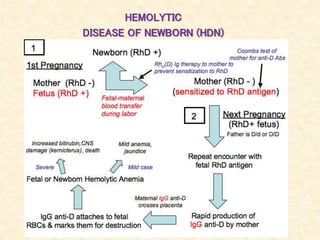 HEMOLYTIC
DISEASE OF NEWBORN (HDN)
 