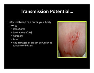 Transmission Potential…
• Infected blood can enter your body
through:
• Open Sores
• Lacerations (Cuts)
• Abrasions
• Acne
• Any damaged or broken skin, such as
sunburn or blisters.
 