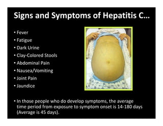Signs and Symptoms of Hepatitis C…
• Fever
• Fatigue
• Dark Urine
• Clay‐Colored Stools
• Abdominal Pain
• Nausea/Vomiting
• Joint Pain
• Jaundice
• In those people who do develop symptoms, the average
time period from exposure to symptom onset is 14‐180 days
(Average is 45 days).
 