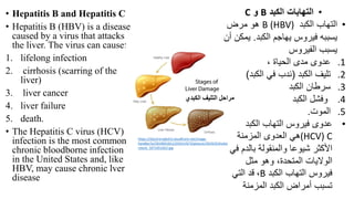 • Hepatitis B and Hepatitis C
• Hepatitis B (HBV) is a disease
caused by a virus that attacks
the liver. The virus can cause:
1. lifelong infection
2. cirrhosis (scarring of the
liver)
3. liver cancer
4. liver failure
5. death.
• The Hepatitis C virus (HCV)
infection is the most common
chronic bloodborne infection
in the United States and, like
HBV, may cause chronic lver
disease
•
‫الكبد‬ ‫التهابات‬
B
‫و‬
C
•
‫الكبد‬ ‫التهاب‬
B (HBV)
‫مرض‬ ‫هو‬
‫الكبد‬ ‫يهاجم‬ ‫فيروس‬ ‫يسببه‬
.
‫ي‬
‫أن‬ ‫مكن‬
‫الفيروس‬ ‫يسبب‬
.1
، ‫الحياة‬ ‫مدى‬ ‫عدوى‬
.2
‫الكبد‬ ‫تليف‬
(
‫الكبد‬ ‫في‬ ‫ندب‬
)
.3
‫الكبد‬ ‫سرطان‬
.4
‫الكبد‬ ‫وفشل‬
.5
‫الموت‬
.
•
‫الكبد‬ ‫التهاب‬ ‫فيروس‬ ‫عدوى‬
(HCV) C
‫المزمنة‬ ‫العدوى‬ ‫هي‬
‫ف‬ ‫بالدم‬ ‫والمنقولة‬ ‫شيوعا‬ ‫األكثر‬
‫ي‬
‫مثل‬ ‫وهو‬ ،‫المتحدة‬ ‫الواليات‬
‫الكبد‬ ‫التهاب‬ ‫فيروس‬
B
،
‫التي‬ ‫قد‬
‫المزمنة‬ ‫الكبد‬ ‫أمراض‬ ‫تسبب‬
https://d2jx2rerrg6sh3.cloudfront.net/image-
handler/ts/20190318112333/ri/673/picture/2019/3/shutte
rstock_1071451652.jpg
‫الكبدي‬ ‫التليف‬ ‫مراحل‬
 