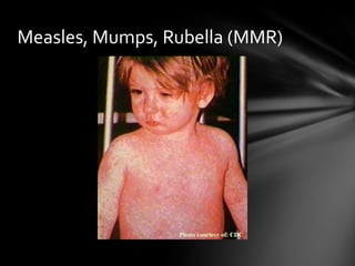 Measles, Mumps, Rubella (MMR)
 