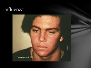 Influenza
 