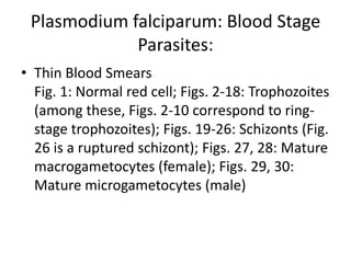 Plasmodium falciparum: Blood Stage
Parasites:
• Thin Blood Smears
Fig. 1: Normal red cell; Figs. 2-18: Trophozoites
(among these, Figs. 2-10 correspond to ring-
stage trophozoites); Figs. 19-26: Schizonts (Fig.
26 is a ruptured schizont); Figs. 27, 28: Mature
macrogametocytes (female); Figs. 29, 30:
Mature microgametocytes (male)
 