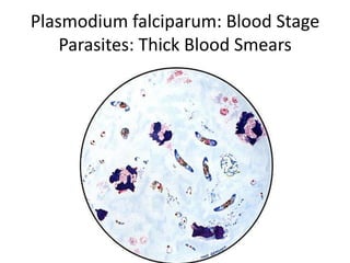 Plasmodium falciparum: Blood Stage
Parasites: Thick Blood Smears
 
