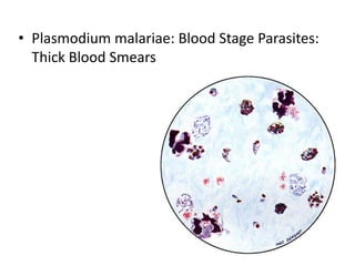 • Plasmodium malariae: Blood Stage Parasites:
Thick Blood Smears
 