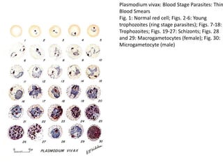 Plasmodium vivax: Blood Stage Parasites: Thin
Blood Smears
Fig. 1: Normal red cell; Figs. 2-6: Young
trophozoites (ring stage parasites); Figs. 7-18:
Trophozoites; Figs. 19-27: Schizonts; Figs. 28
and 29: Macrogametocytes (female); Fig. 30:
Microgametocyte (male)
 