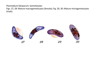Plasmodium falciparum: Gametocytes
Figs. 27, 28: Mature macrogametocytes (female); Fig. 29, 30: Mature microgametocytes
(male)
 