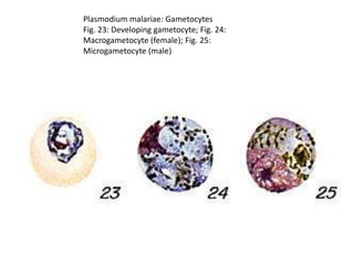 Plasmodium malariae: Gametocytes
Fig. 23: Developing gametocyte; Fig. 24:
Macrogametocyte (female); Fig. 25:
Microgametocyte (male)
 