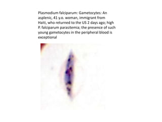 Plasmodium falciparum: Gametocytes: An
asplenic, 41 y.o. woman, immigrant from
Haiti, who returned to the US 2 days ago; high
P. falciparum parasitemia; the presence of such
young gametocytes in the peripheral blood is
exceptional
 
