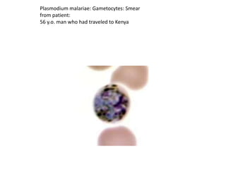 Plasmodium malariae: Gametocytes: Smear
from patient:
56 y.o. man who had traveled to Kenya
 