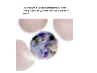 Plasmodium malariae: Gametocytes: Smear
from patient: 56 y.o. man who had traveled to
Kenya
 