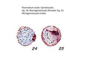Plasmodium ovale: Gametocytes
Fig. 24: Macrogametocyte (female); Fig. 25:
Microgametocyte (male).
 