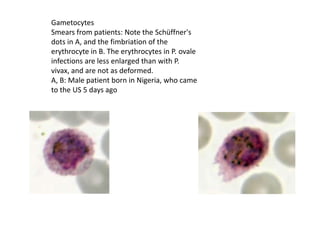 Gametocytes
Smears from patients: Note the Schüffner's
dots in A, and the fimbriation of the
erythrocyte in B. The erythrocytes in P. ovale
infections are less enlarged than with P.
vivax, and are not as deformed.
A, B: Male patient born in Nigeria, who came
to the US 5 days ago
 