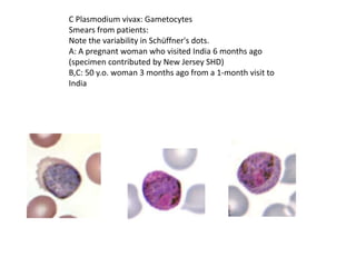 C Plasmodium vivax: Gametocytes
Smears from patients:
Note the variability in Schüffner's dots.
A: A pregnant woman who visited India 6 months ago
(specimen contributed by New Jersey SHD)
B,C: 50 y.o. woman 3 months ago from a 1-month visit to
India
 