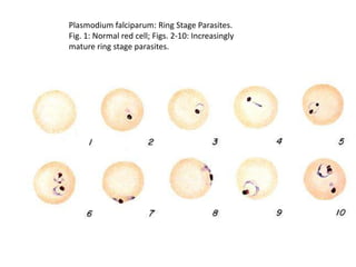 Plasmodium falciparum: Ring Stage Parasites.
Fig. 1: Normal red cell; Figs. 2-10: Increasingly
mature ring stage parasites.
 