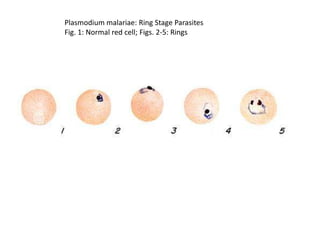 Plasmodium malariae: Ring Stage Parasites
Fig. 1: Normal red cell; Figs. 2-5: Rings
 