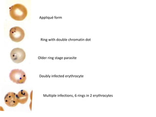 Appliqué form
Ring with double chromatin dot
Older ring stage parasite
Doubly infected erythrocyte
Multiple infections, 6 rings in 2 erythrocytes
 