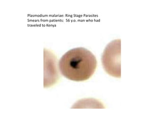 Plasmodium malariae: Ring Stage Parasites
Smears from patients: 56 y.o. man who had
traveled to Kenya
 