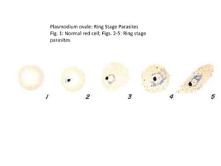 Plasmodium ovale: Ring Stage Parasites
Fig. 1: Normal red cell; Figs. 2-5: Ring stage
parasites
 